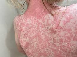 Crece a 41 casos de Sarampión en Tabasco 