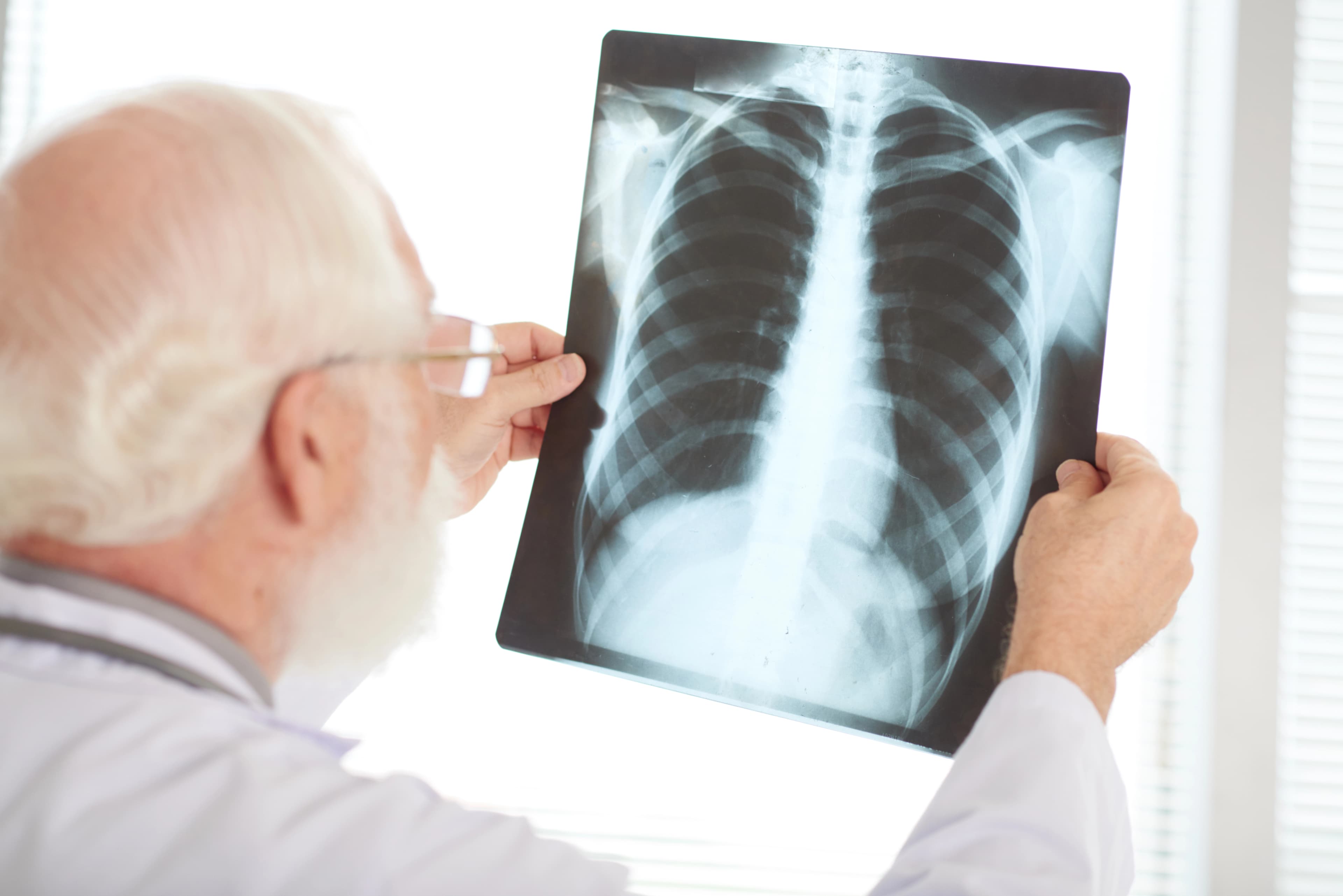 Registran 61 casos de Tuberculosis pulmonar en Tabasco 