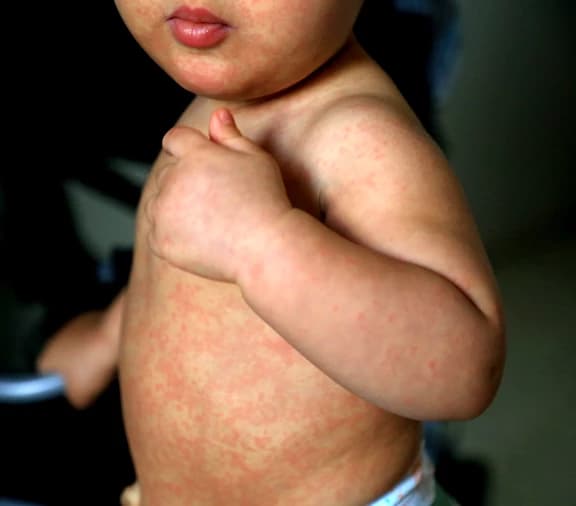 Muere bebé rarámuri de 11 meses por sarampión