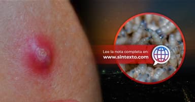 ImagenRepunta Gusano Barrenador en humanos en Tabasco