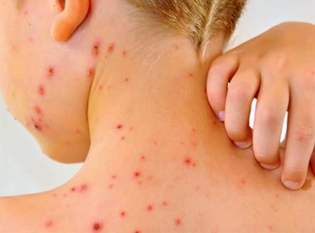 Registra Chiapas primera muerte por Sarampión 