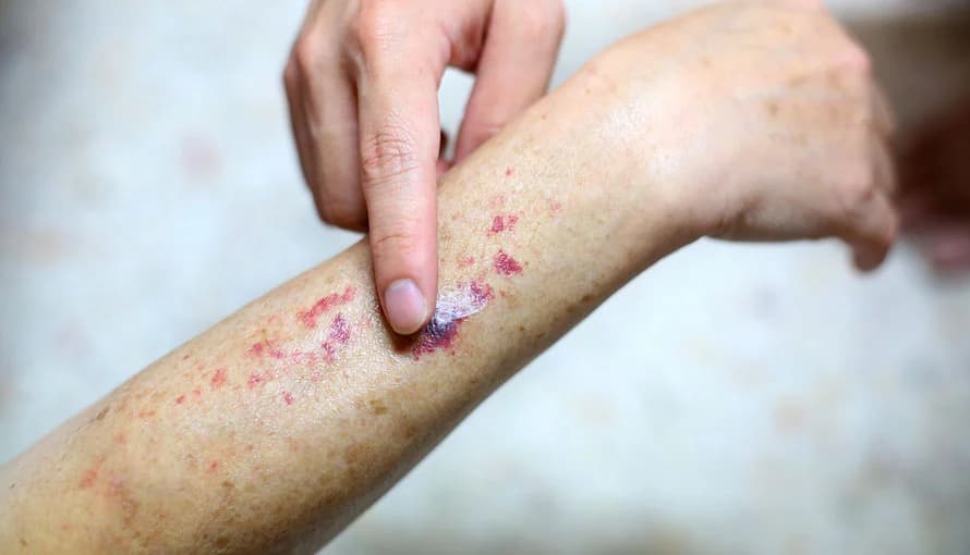 Examen de sangre detecta riesgo de leucemia, según estudio