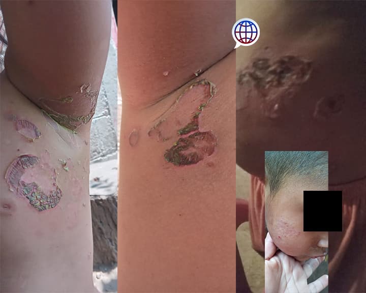 Alertan por rara enfermedad en niños 