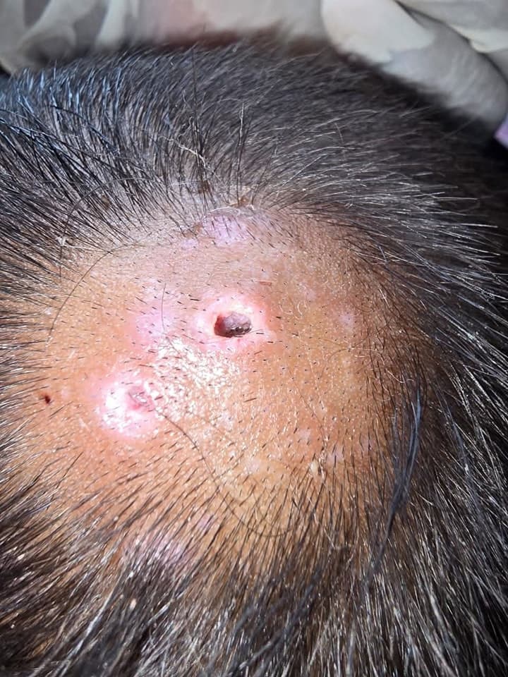 Chiapas registra primer caso humano de gusano barrenador