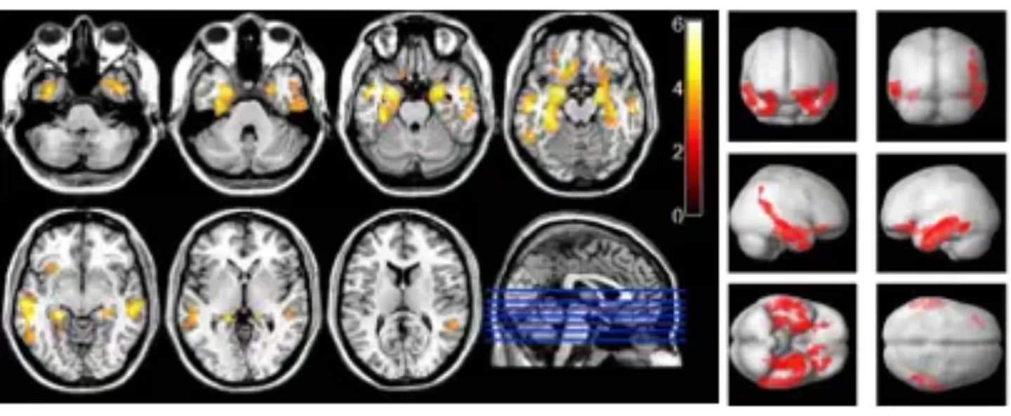 Probióticos podrían desempeñar papel clave en prevención de Alzheimer