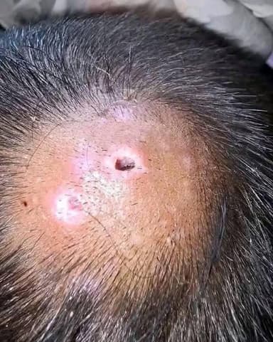 ImagenPrimer caso de gusano barrenador en mujer de Campeche 