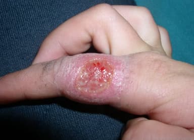 ImagenReportan 4 casos de Leishmaniasis en Campeche