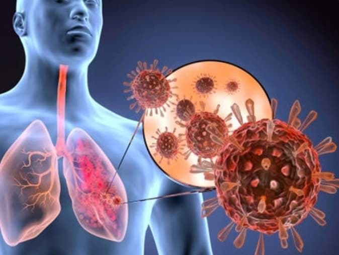 IMSS Veracruz alerta sobre Virus Sincitial Respiratorio