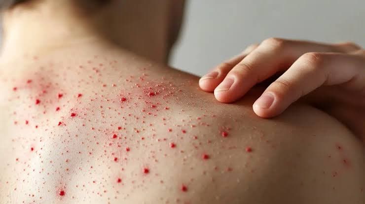 Descartan brote de sarampión en Tabasco
