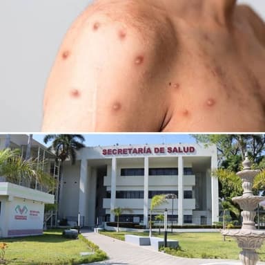 ImagenConfirman caso de Viruela Símica en Chiapas