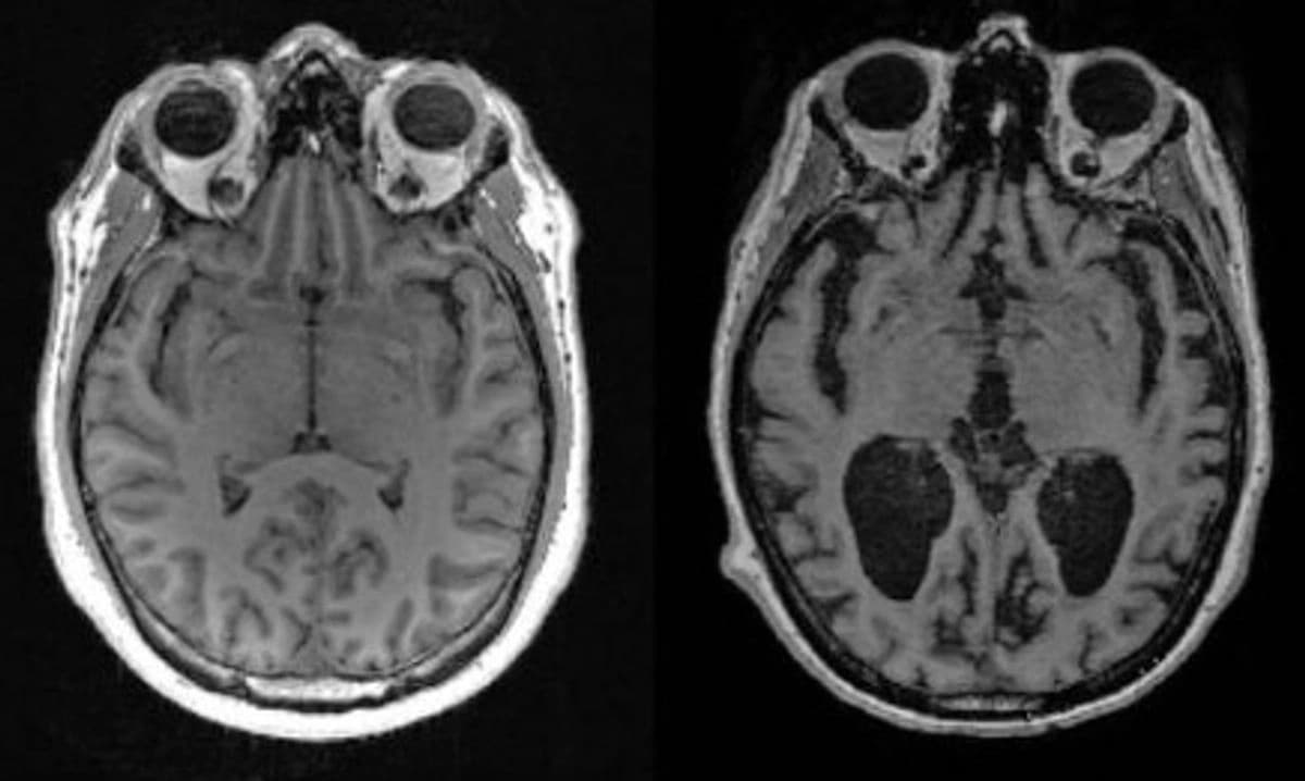 Científicos descubren que deficiencia de litio provoca Alzheimer