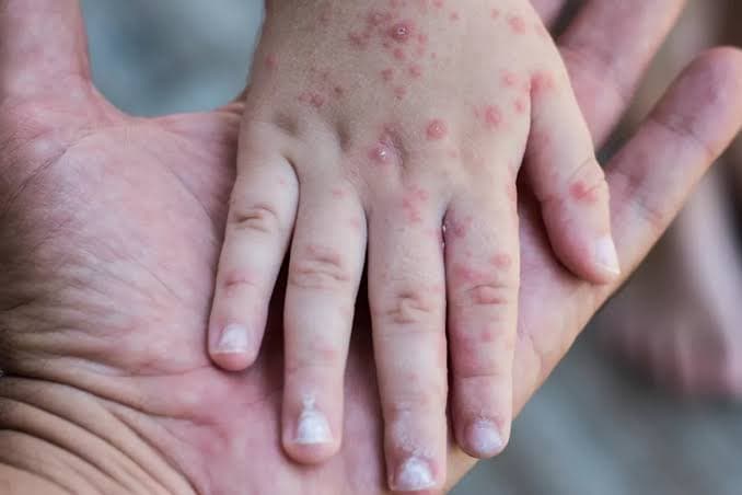 Minimiza Salud brote de Coxsackie: 'no representa riesgo'