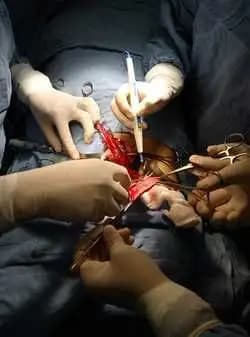 Médicos chinos implantan corazón artificial más pequeño del mundo