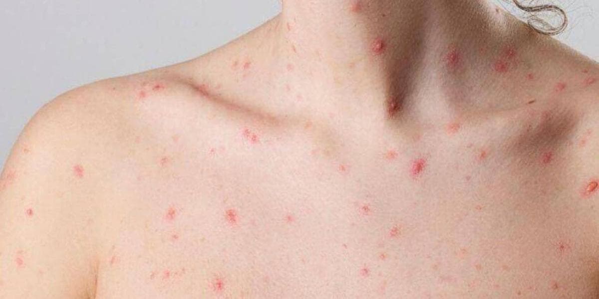 49 casos de MPOX en México