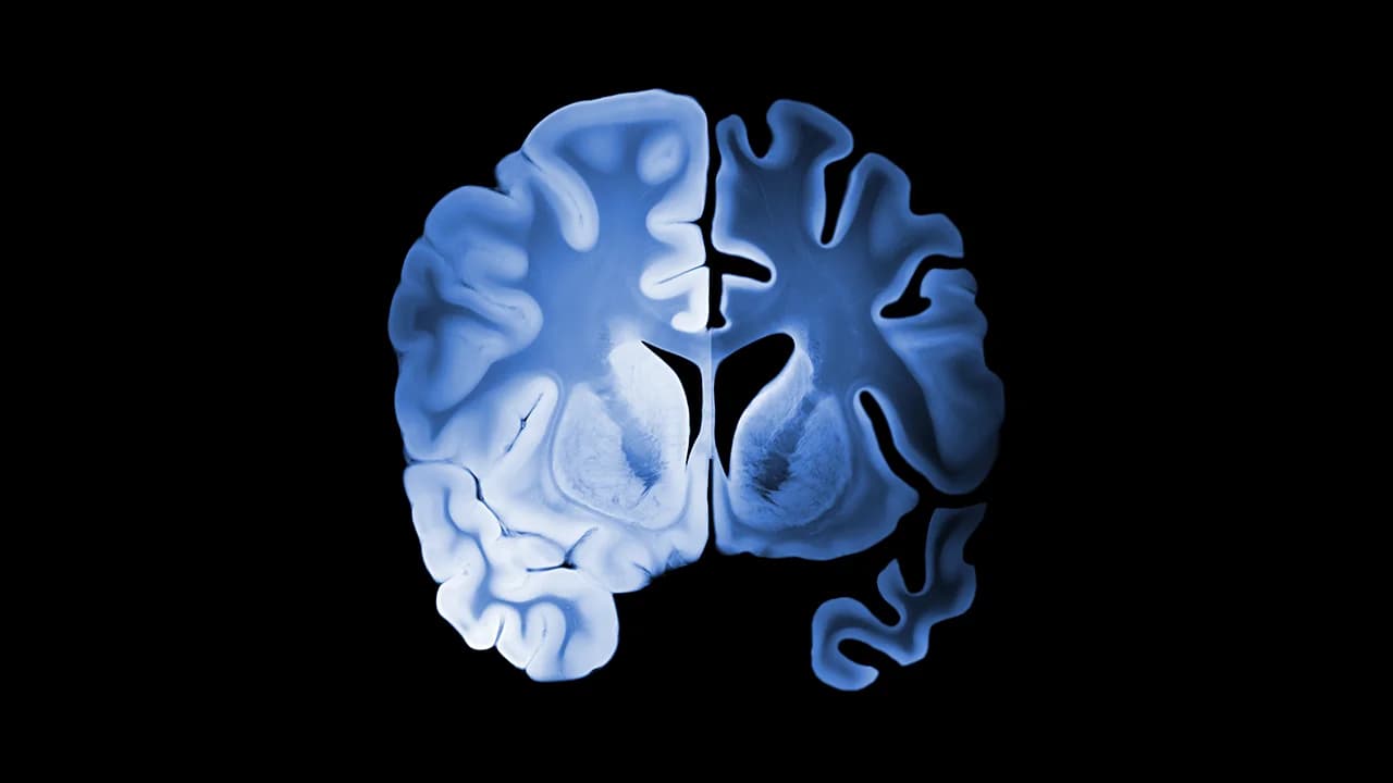 Un análisis de sangre predice el riesgo de Alzheimer con una década de antelación
