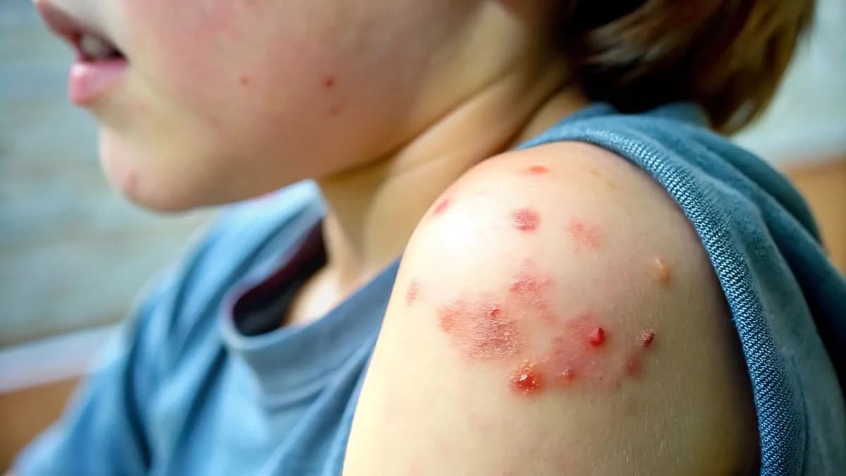 Suben a 31 fallecidos por Sarampión en México