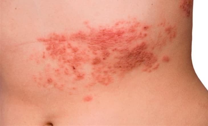 Registran casos de varicela en la zona maya